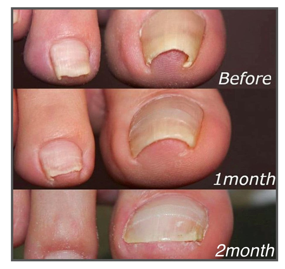 NailAlign™ | Corrective Patches for Beautiful and Healthy Nails