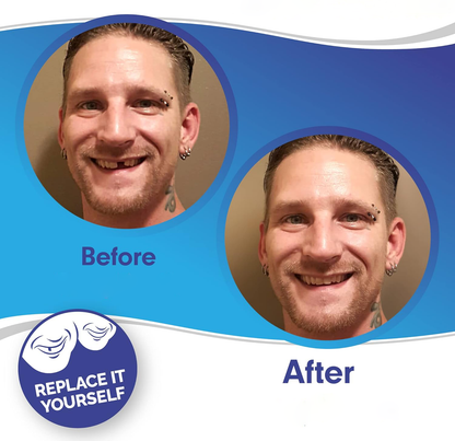 InstaSmile Shield™ (Top & Bottom Set Included)