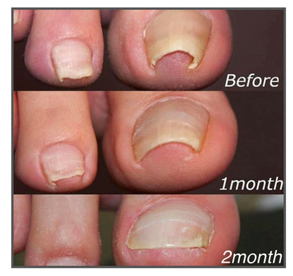 NailAlign™ | Corrective Patches for Beautiful and Healthy Nails